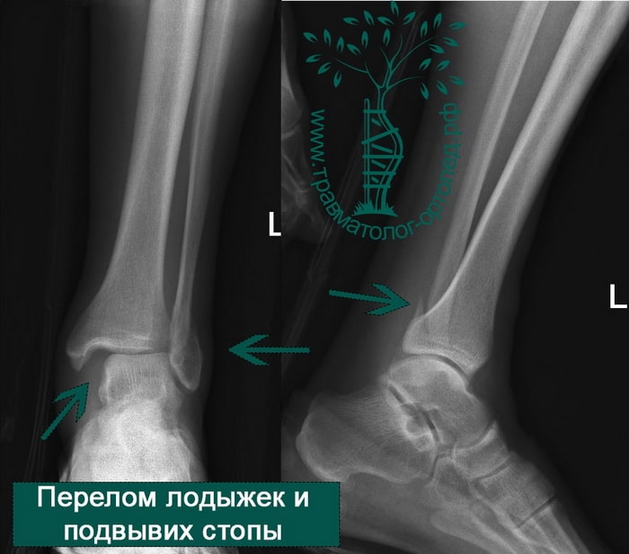 Реферат: Переломы лодыжек, повреждения голеностопного сустава